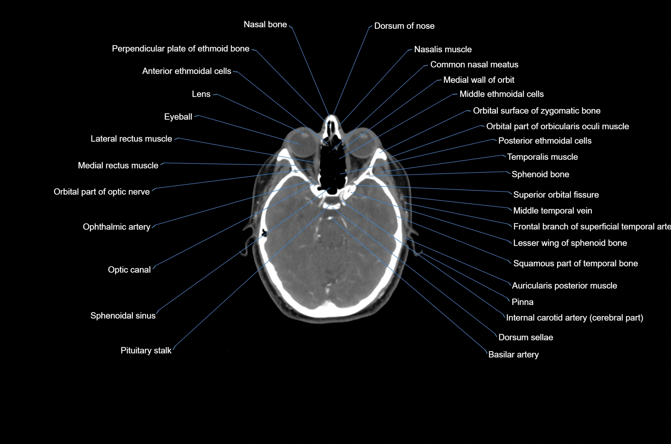 CT Neck axial cross sectional anatomy radiology image-img-00001-00007.webp